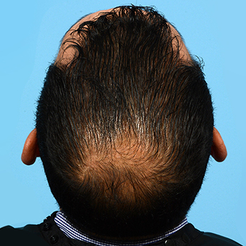 Fue Before and After | Dr. Jeffrey Wise