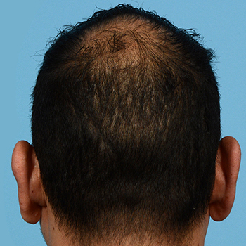 Fue Before and After | Dr. Jeffrey Wise