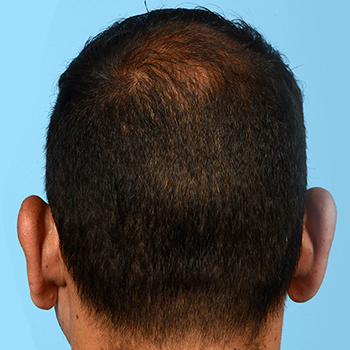 Fue Before and After | Dr. Jeffrey Wise