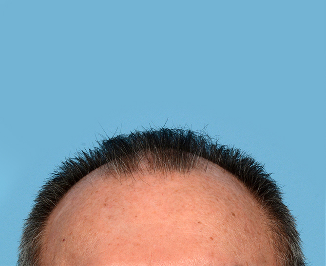 Fue Before and After | Dr. Jeffrey Wise