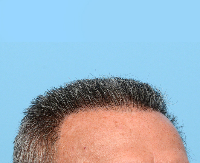 Fue Before and After | Dr. Jeffrey Wise