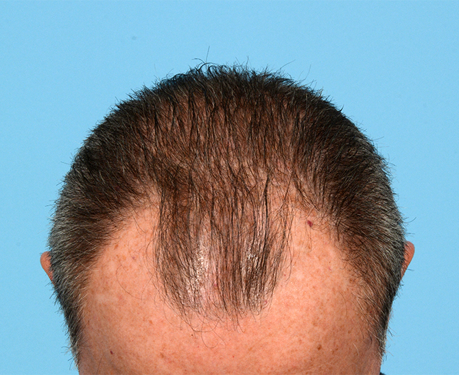 Fue Before and After | Dr. Jeffrey Wise