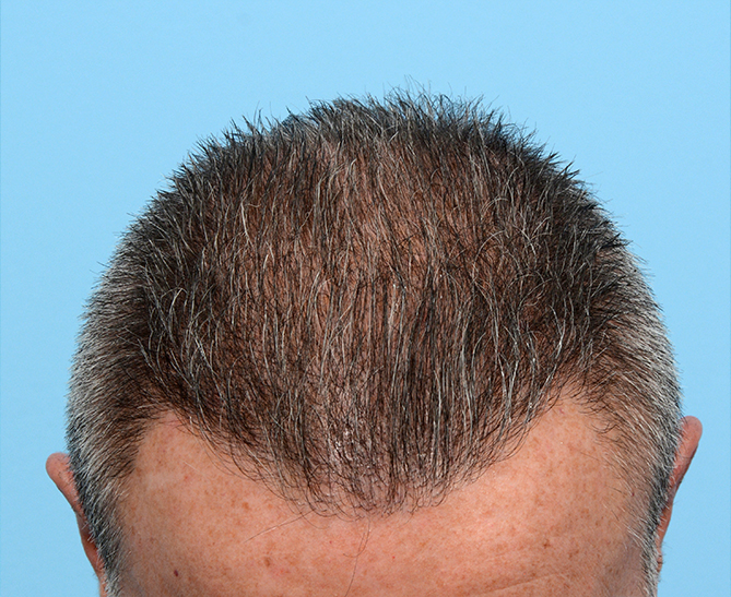 Fue Before and After | Dr. Jeffrey Wise