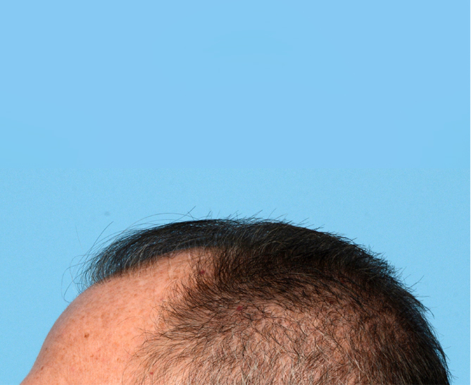 Fue Before and After | Dr. Jeffrey Wise