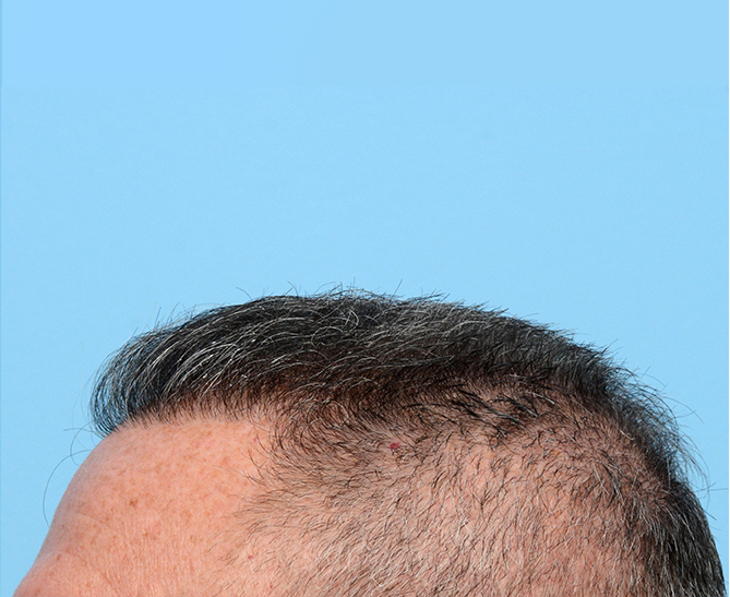 Fue Before and After | Dr. Jeffrey Wise