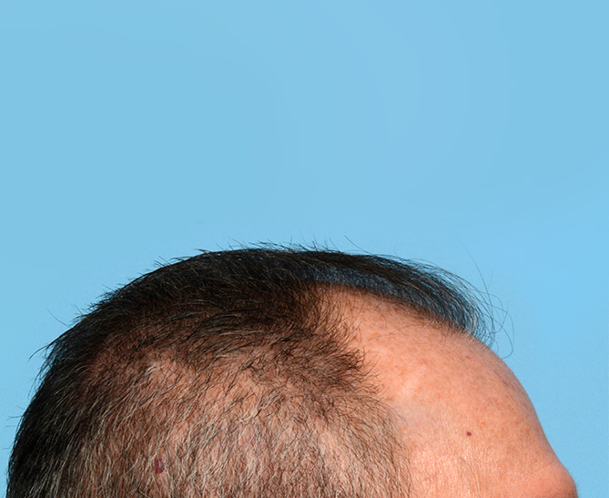 Fue Before and After | Dr. Jeffrey Wise