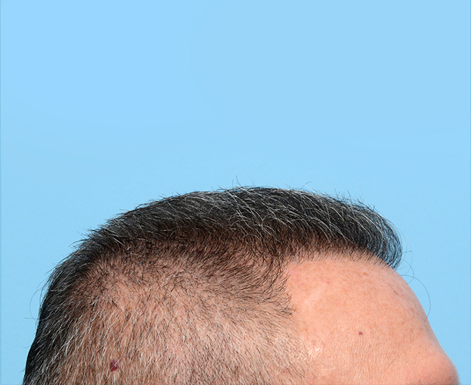 Fue Before and After | Dr. Jeffrey Wise