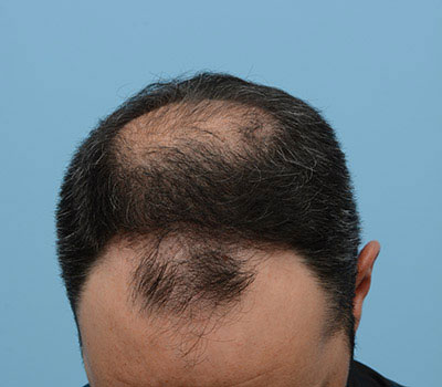 Fue Before and After | Dr. Jeffrey Wise