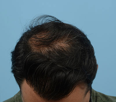 Fue Before and After | Dr. Jeffrey Wise