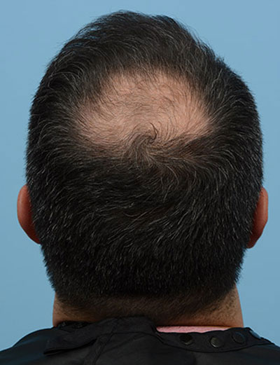 Fue Before and After | Dr. Jeffrey Wise