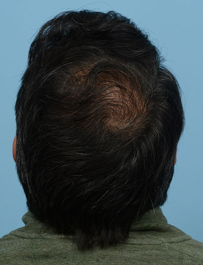 Fue Before and After | Dr. Jeffrey Wise