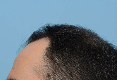 Fue Before and After | Dr. Jeffrey Wise