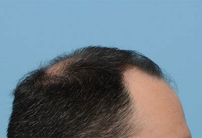 Fue Before and After | Dr. Jeffrey Wise