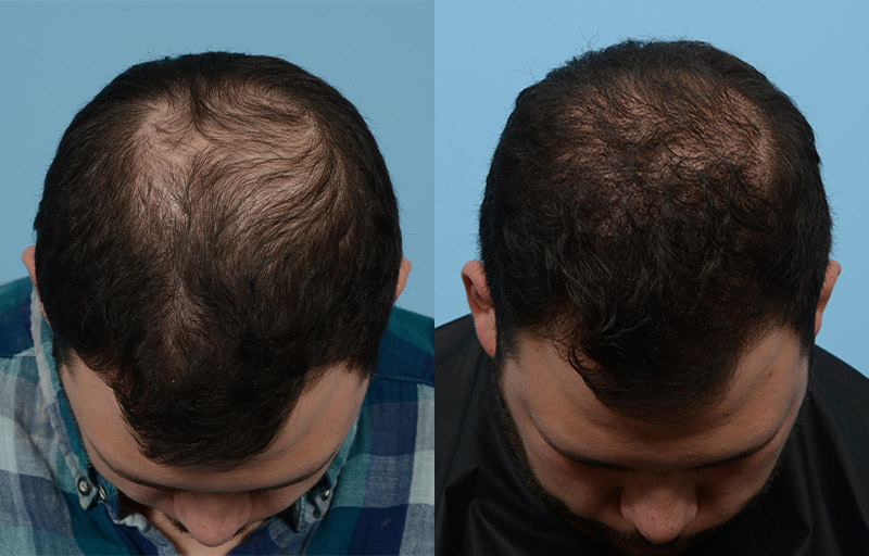 FUE Before & After 44
