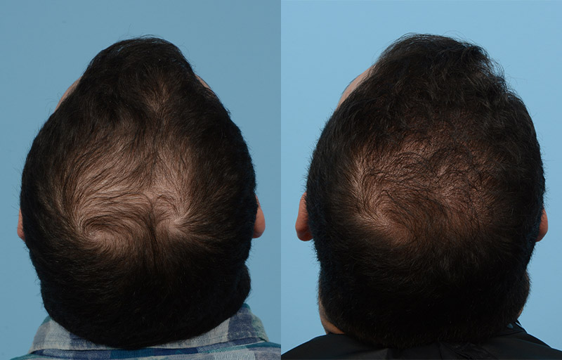 FUE Before & After 44