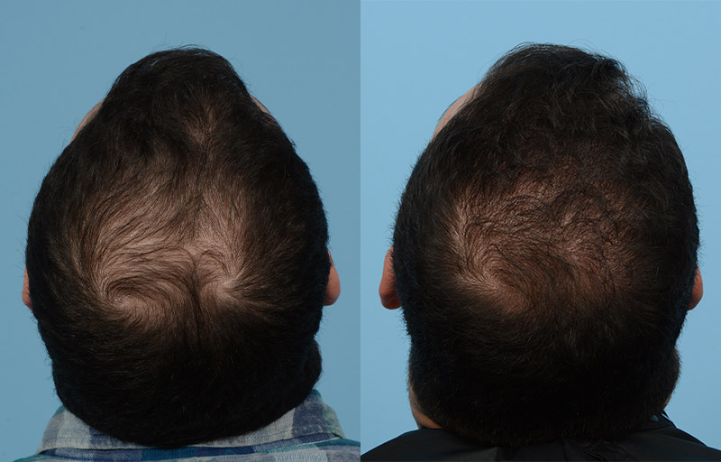 Fue Before and After | Dr. Jeffrey Wise