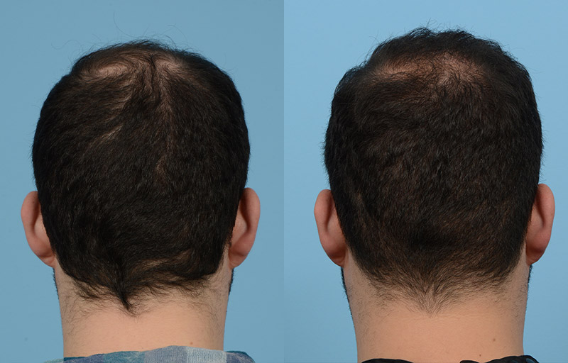 Fue Before and After | Dr. Jeffrey Wise