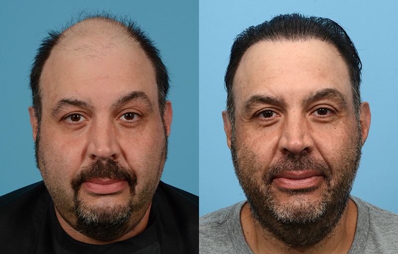 Fue Before and After | Dr. Jeffrey Wise