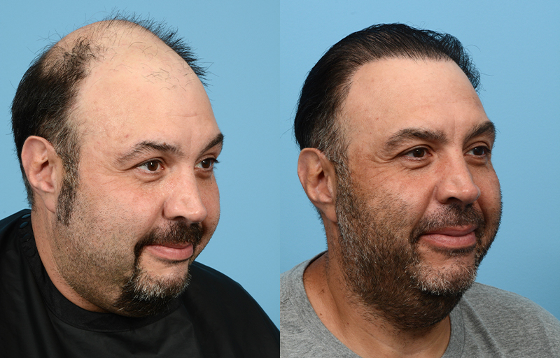 Fue Before and After | Dr. Jeffrey Wise