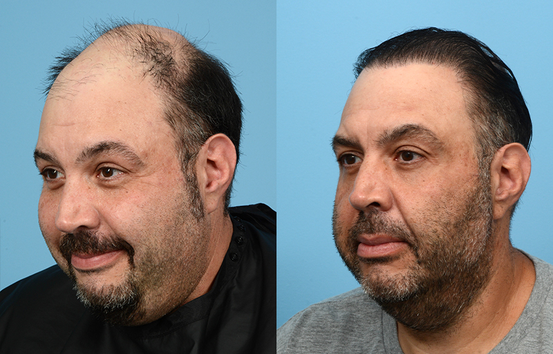 Fue Before and After | Dr. Jeffrey Wise