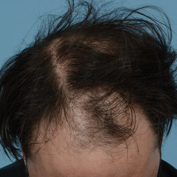 Fue Before and After | Dr. Jeffrey Wise