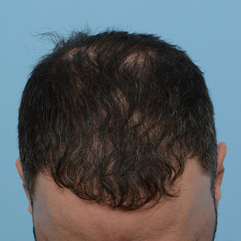 Fue Before and After | Dr. Jeffrey Wise