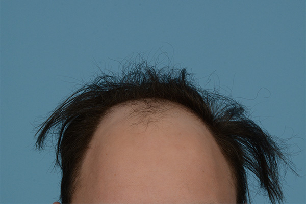 Fue Before and After | Dr. Jeffrey Wise