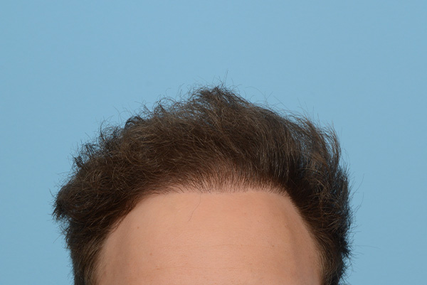 Fue Before and After | Dr. Jeffrey Wise