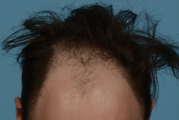 Fue Before and After | Dr. Jeffrey Wise