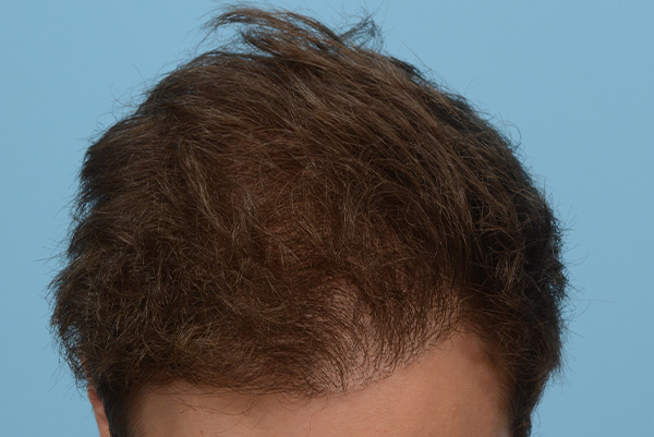 Fue Before and After | Dr. Jeffrey Wise