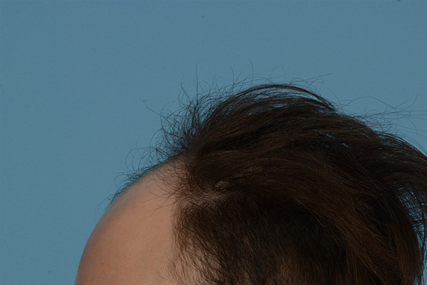 Fue Before and After | Dr. Jeffrey Wise