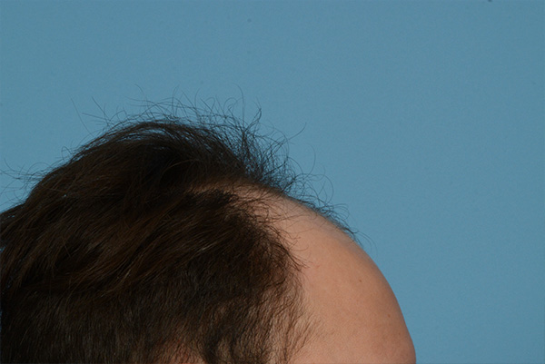 Fue Before and After | Dr. Jeffrey Wise