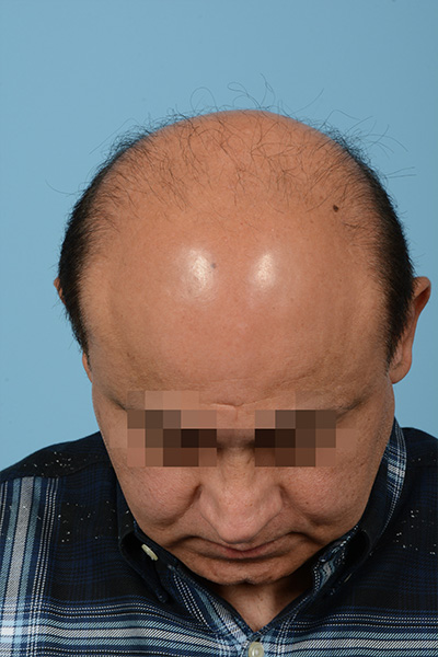 Fue Before and After | Dr. Jeffrey Wise