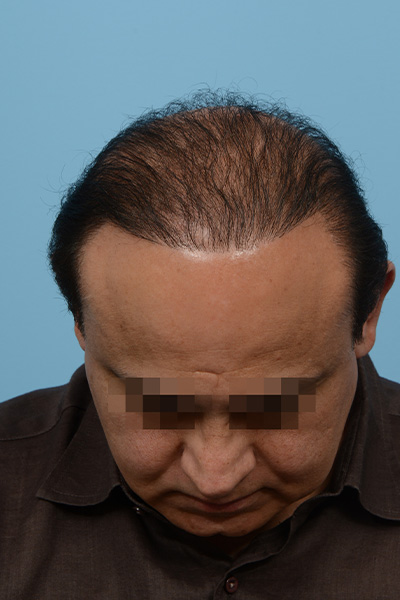 Fue Before and After | Dr. Jeffrey Wise