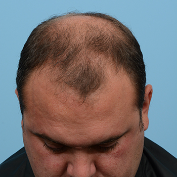 Fue Before and After | Dr. Jeffrey Wise