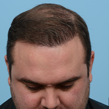 Fue Before and After | Dr. Jeffrey Wise