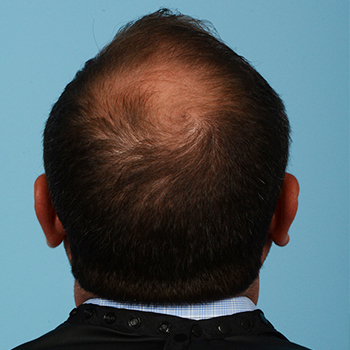 Fue Before and After | Dr. Jeffrey Wise