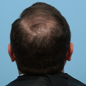 Fue Before and After | Dr. Jeffrey Wise