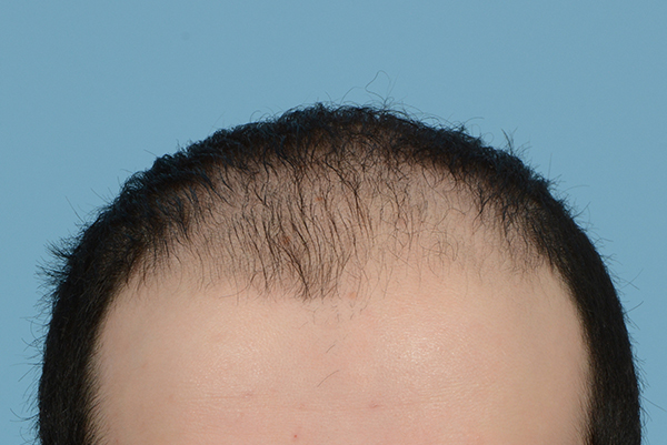 Fue Before and After | Dr. Jeffrey Wise