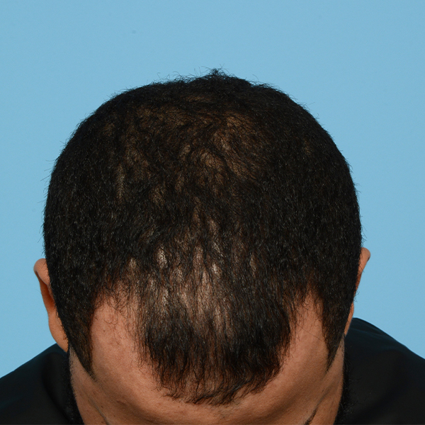 Fue Before and After | Dr. Jeffrey Wise