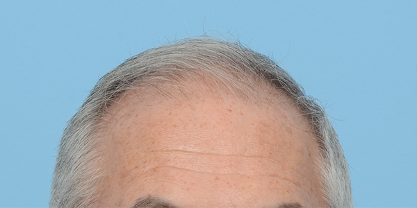 Fue Before and After | Dr. Jeffrey Wise