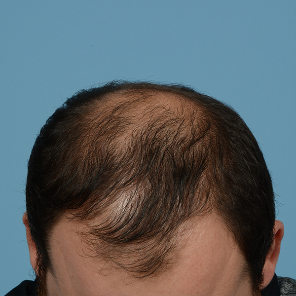 Fue Before and After | Dr. Jeffrey Wise