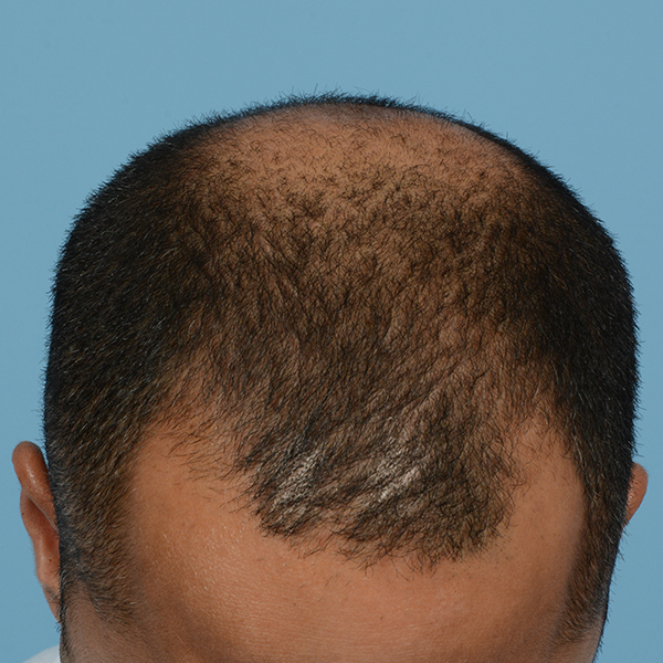 Fue Before and After | Dr. Jeffrey Wise