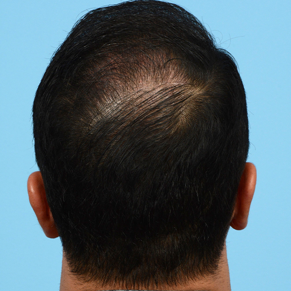 Fue Before and After | Dr. Jeffrey Wise