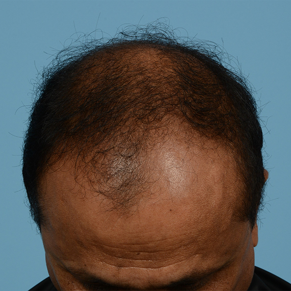 Fue Before and After | Dr. Jeffrey Wise