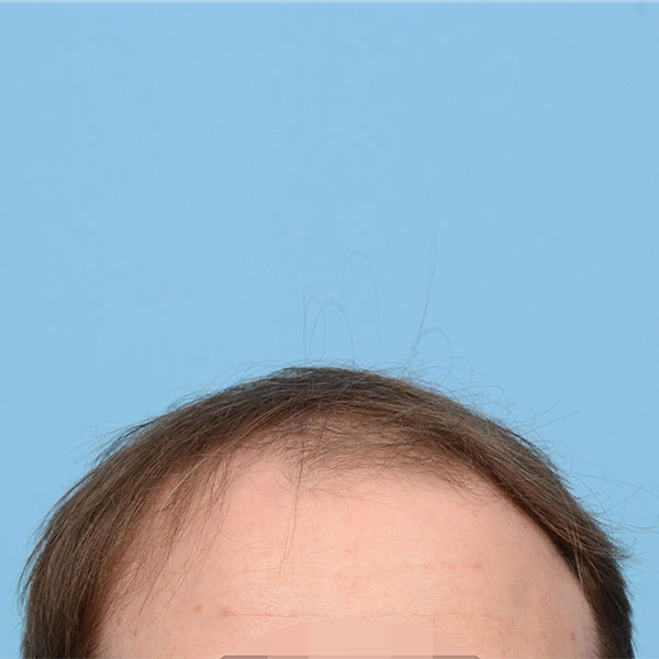 Fue Before and After | Dr. Jeffrey Wise