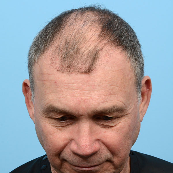 Fue Before and After | Dr. Jeffrey Wise