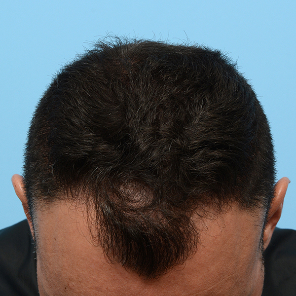 Fue Before and After | Dr. Jeffrey Wise