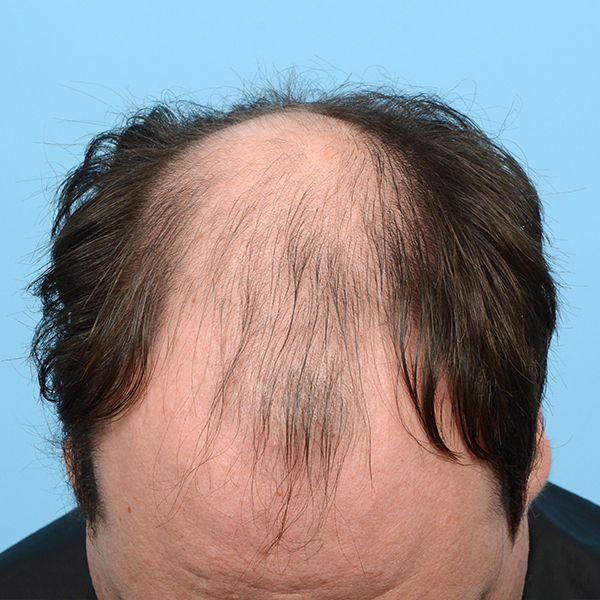 Fue Before and After | Dr. Jeffrey Wise