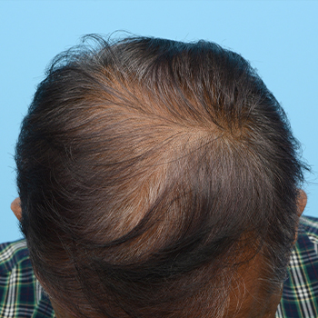 Fue Before and After | Dr. Jeffrey Wise